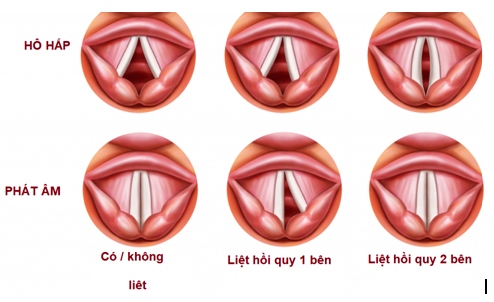 Bị khan tiếng, đi khám, phát hiện ra ung thư thực quản!